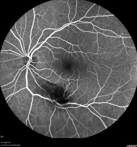 Acquired Toxoplasmosis Retinitis Para Foveal - Following Venison Consumption
56 year old man who became very sick after eating venison at the end of December 2019.  Presented 6 weeks later with a scotoma.  Initial photos show presentation with 20/63 vision.  Vision dropped to 5/200.  All tests (including PCR of anterior chamber tap) were negative except serum toxoplasmosis IgG and IgM.  Vision improved to 20/32 but the scotoma remained on oral trimetheprim/sulfa
