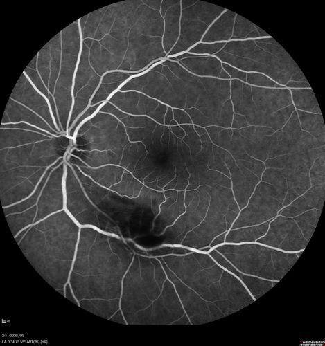 Acquired Toxoplasmosis Retinitis Para Foveal - Following Venison Consumption
56 year old man who became very sick after eating venison at the end of December 2019.  Presented 6 weeks later with a scotoma.  Initial photos show presentation with 20/63 vision.  Vision dropped to 5/200.  All tests (including PCR of anterior chamber tap) were negative except serum toxoplasmosis IgG and IgM.  Vision improved to 20/32 but the scotoma remained on oral trimetheprim/sulfa
