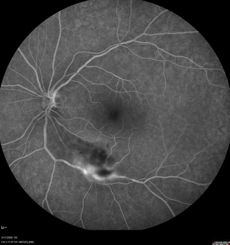 Acquired Toxoplasmosis Retinitis Para Foveal - Following Venison Consumption
56 year old man who became very sick after eating venison at the end of December 2019.  Presented 6 weeks later with a scotoma.  Initial photos show presentation with 20/63 vision.  Vision dropped to 5/200.  All tests (including PCR of anterior chamber tap) were negative except serum toxoplasmosis IgG and IgM.  Vision improved to 20/32 but the scotoma remained on oral trimetheprim/sulfa
