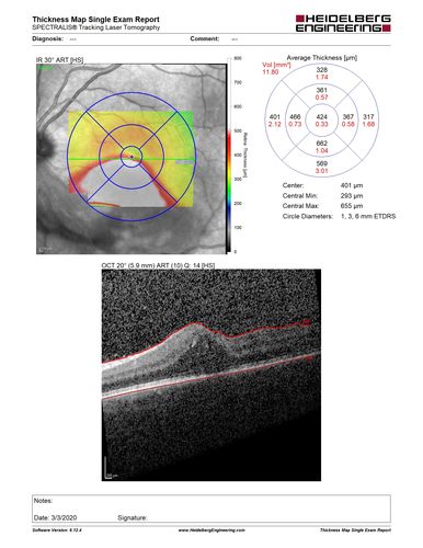 Acquired Toxoplasmosis Retinitis Para Foveal - Following Venison Consumption
56 year old man who became very sick after eating venison at the end of December 2019.  Presented 6 weeks later with a scotoma.  Initial photos show presentation with 20/63 vision.  Vision dropped to 5/200.  All tests (including PCR of anterior chamber tap) were negative except serum toxoplasmosis IgG and IgM.  Vision improved to 20/32 but the scotoma remained on oral trimetheprim/sulfa

