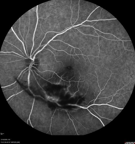 Acquired Toxoplasmosis Retinitis Para Foveal - Following Venison Consumption
56 year old man who became very sick after eating venison at the end of December 2019.  Presented 6 weeks later with a scotoma.  Initial photos show presentation with 20/63 vision.  Vision dropped to 5/200.  All tests (including PCR of anterior chamber tap) were negative except serum toxoplasmosis IgG and IgM.  Vision improved to 20/32 but the scotoma remained on oral trimetheprim/sulfa
