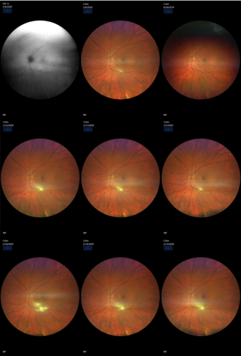 Acquired Toxoplasmosis Retinitis Para Foveal - Following Venison Consumption
56 year old man who became very sick after eating venison at the end of December 2019.  Presented 6 weeks later with a scotoma.  Initial photos show presentation with 20/63 vision.  Vision dropped to 5/200.  All tests (including PCR of anterior chamber tap) were negative except serum toxoplasmosis IgG and IgM.  Vision improved to 20/32 but the scotoma remained on oral trimetheprim/sulfa
