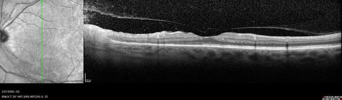 Acquired Toxoplasmosis Retinitis Para Foveal - Following Venison Consumption
56 year old man who became very sick after eating venison at the end of December 2019.  Presented 6 weeks later with a scotoma.  Initial photos show presentation with 20/63 vision.  Vision dropped to 5/200.  All tests (including PCR of anterior chamber tap) were negative except serum toxoplasmosis IgG and IgM.  Vision improved to 20/32 but the scotoma remained on oral trimetheprim/sulfa
