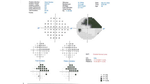 Acquired Toxoplasmosis Retinitis Para Foveal - Following Venison Consumption
56 year old man who became very sick after eating venison at the end of December 2019.  Presented 6 weeks later with a scotoma.  Initial photos show presentation with 20/63 vision.  Vision dropped to 5/200.  All tests (including PCR of anterior chamber tap) were negative except serum toxoplasmosis IgG and IgM.  Vision improved to 20/32 but the scotoma remained on oral trimetheprim/sulfa
