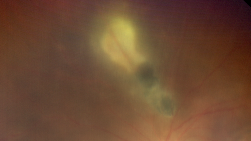 Recurrent Toxoplasmosis - Resolves with no treatment
36 year old man with recent vision loss.  He has a sulfa allergy.  The eye was NOT treated and the uveitis resolved in about 6 weeks.
