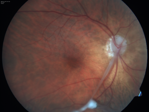Toxocariasis - Stalk from optic nerve to peripheral scar
