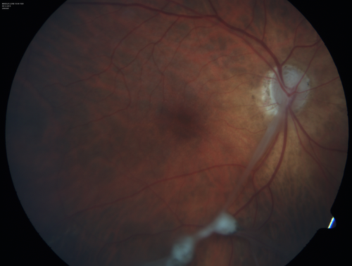 Toxocariasis - Stalk from optic nerve to peripheral scar
