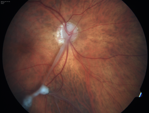 Toxocariasis - Stalk from optic nerve to peripheral scar
