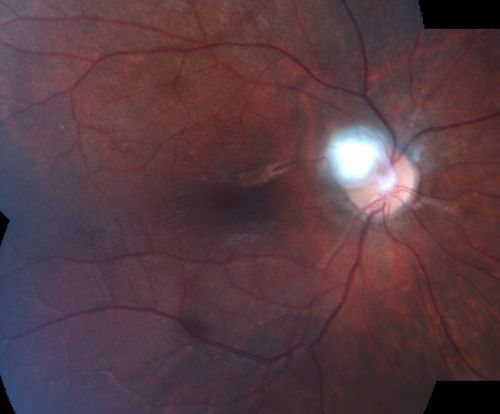 Toxocariasis
15-year-old one year ago  had pink eye then her vision has been abnormal.  She recently went for a driversâ€™ test and failed,  OD:  20/80;  OS:  20/20. 
Keywords: Toxocariasis