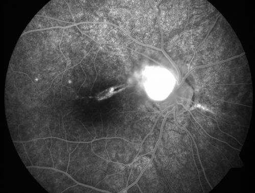 Toxocariasis
15-year-old one year ago  had pink eye then her vision has been abnormal.  She recently went for a driversâ€™ test and failed,  OD:  20/80;  OS:  20/20. 
Keywords: Toxocariasis