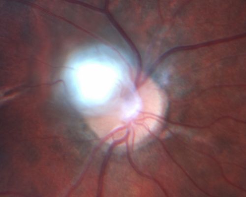 Toxocariasis
15-year-old one year ago  had pink eye then her vision has been abnormal.  She recently went for a driversâ€™ test and failed,  OD:  20/80;  OS:  20/20. 
Keywords: Toxocariasis