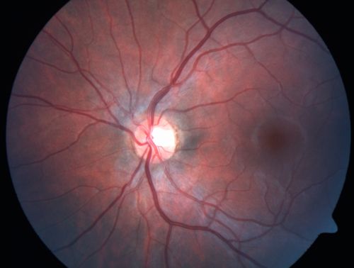 Toxocariasis
15-year-old one year ago  had pink eye then her vision has been abnormal.  She recently went for a driversâ€™ test and failed,  OD:  20/80;  OS:  20/20. 
Keywords: Toxocariasis