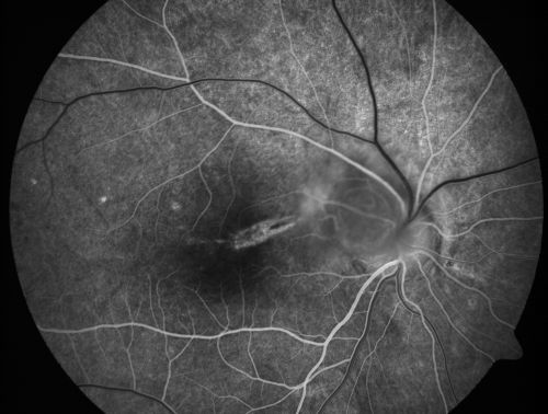 Toxocariasis
15-year-old one year ago  had pink eye then her vision has been abnormal.  She recently went for a driversâ€™ test and failed,  OD:  20/80;  OS:  20/20. 
Keywords: Toxocariasis