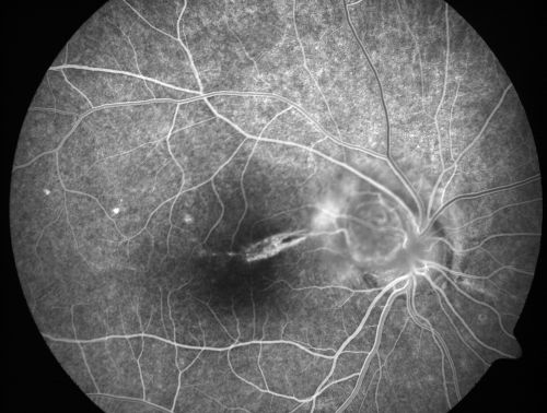 Toxocariasis
15-year-old one year ago  had pink eye then her vision has been abnormal.  She recently went for a driversâ€™ test and failed,  OD:  20/80;  OS:  20/20. 
Keywords: Toxocariasis