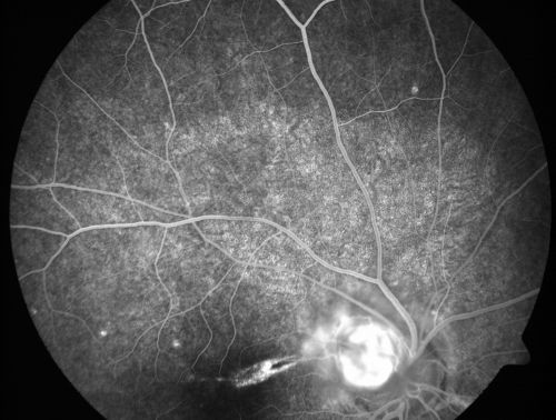 Toxocariasis
15-year-old one year ago  had pink eye then her vision has been abnormal.  She recently went for a driversâ€™ test and failed,  OD:  20/80;  OS:  20/20. 
Keywords: Toxocariasis