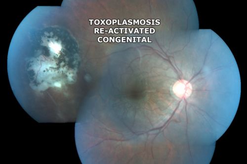 Congenital Toxoplasmosis with non-macular Scars Both Eyes - Recent Reactivation (recurrence) Right Eye
34-year-old man has congenital toxoplasmosis with four week history of foggy vision and new floaters in the right eye. OD is 20/40, OS 20/30

