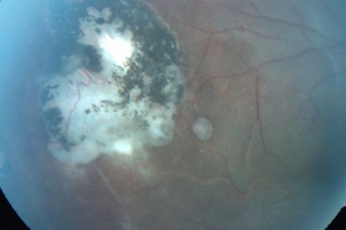 Congenital Toxoplasmosis with non-macular Scars Both Eyes - Recent Reactivation (recurrence) Right Eye
34-year-old man has congenital toxoplasmosis with four week history of foggy vision and new floaters in the right eye. OD is 20/40, OS 20/30
