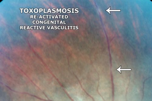 Congenital Toxoplasmosis with non-macular Scars Both Eyes - Recent Reactivation (recurrence) Right Eye
34-year-old man has congenital toxoplasmosis with four week history of foggy vision and new floaters in the right eye. OD is 20/40, OS 20/30
