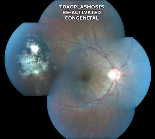 Congenital Toxoplasmosis with non-macular Scars Both Eyes - Recent Reactivation (recurrence) Right Eye
34-year-old man has congenital toxoplasmosis with four week history of foggy vision and new floaters in the right eye. OD is 20/40, OS 20/30
