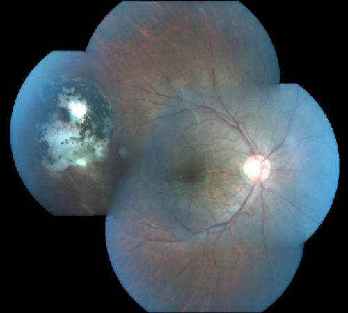 Congenital Toxoplasmosis with non-macular Scars Both Eyes - Recent Reactivation (recurrence) Right Eye
34-year-old man has congenital toxoplasmosis with four week history of foggy vision and new floaters in the right eye. OD is 20/40, OS 20/30
