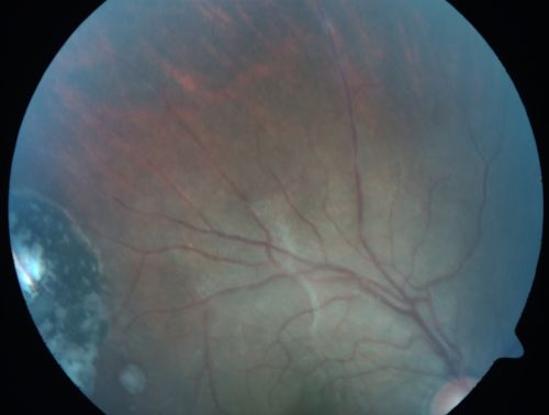 Congenital Toxoplasmosis with non-macular Scars Both Eyes - Recent Reactivation (recurrence) Right Eye
34-year-old man has congenital toxoplasmosis with four week history of foggy vision and new floaters in the right eye. OD is 20/40, OS 20/30
