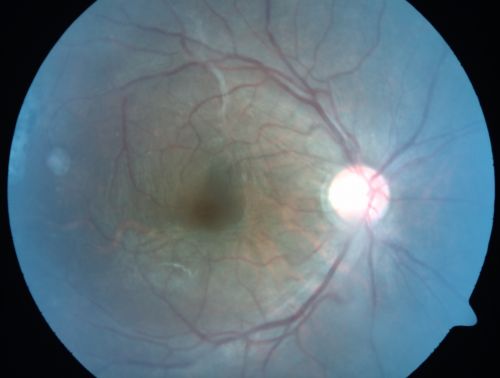 Congenital Toxoplasmosis with non-macular Scars Both Eyes - Recent Reactivation (recurrence) Right Eye
34-year-old man has congenital toxoplasmosis with four week history of foggy vision and new floaters in the right eye. OD is 20/40, OS 20/30
