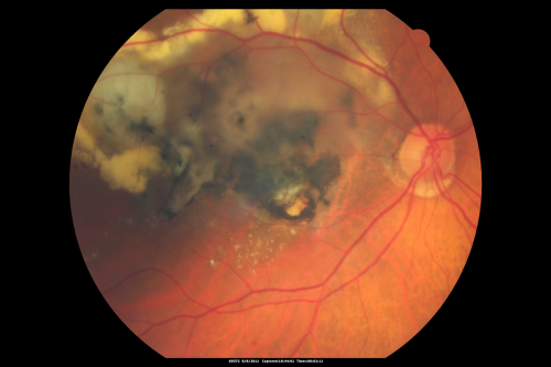 New Subfoveal Classic CNVM OS - Wet AMD - Macular Scar Congenital Toxoplasmosis Right Eye 
77-year-old woman as had poor vision in the right eye since birth from congenital toxoplasmosis of her macula in the right eye.   Two to three weeks ago when she noticed vision loss in the left eye. VISUAL ACUITY:  OD 2/200,  OS 20/200.
