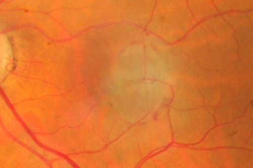 New Subfoveal Classic CNVM OS - Wet AMD - Macular Scar Congenital Toxoplasmosis Right Eye 
77-year-old woman as had poor vision in the right eye since birth from congenital toxoplasmosis of her macula in the right eye.   Two to three weeks ago when she noticed vision loss in the left eye. VISUAL ACUITY:  OD 2/200,  OS 20/200.
