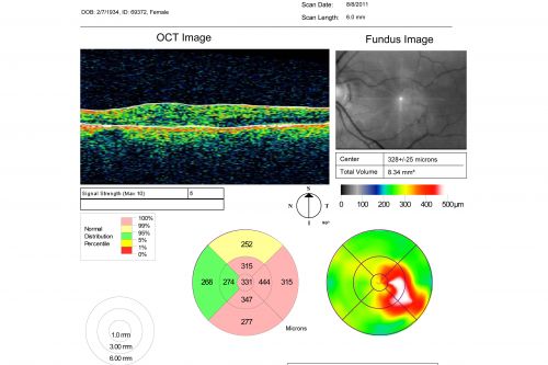 New Subfoveal Classic CNVM OS - Wet AMD - Macular Scar Congenital Toxoplasmosis Right Eye 
77-year-old woman as had poor vision in the right eye since birth from congenital toxoplasmosis of her macula in the right eye.   Two to three weeks ago when she noticed vision loss in the left eye. VISUAL ACUITY:  OD 2/200,  OS 20/200.
