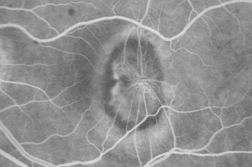 New Subfoveal Classic CNVM OS - Wet AMD - Macular Scar Congenital Toxoplasmosis Right Eye 
77-year-old woman as had poor vision in the right eye since birth from congenital toxoplasmosis of her macula in the right eye.   Two to three weeks ago when she noticed vision loss in the left eye. VISUAL ACUITY:  OD 2/200,  OS 20/200.
