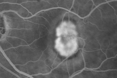 New Subfoveal Classic CNVM OS - Wet AMD - Macular Scar Congenital Toxoplasmosis Right Eye 
77-year-old woman as had poor vision in the right eye since birth from congenital toxoplasmosis of her macula in the right eye.   Two to three weeks ago when she noticed vision loss in the left eye. VISUAL ACUITY:  OD 2/200,  OS 20/200.

