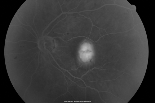 New Subfoveal Classic CNVM OS - Wet AMD - Macular Scar Congenital Toxoplasmosis Right Eye 
77-year-old woman as had poor vision in the right eye since birth from congenital toxoplasmosis of her macula in the right eye.   Two to three weeks ago when she noticed vision loss in the left eye. VISUAL ACUITY:  OD 2/200,  OS 20/200.
