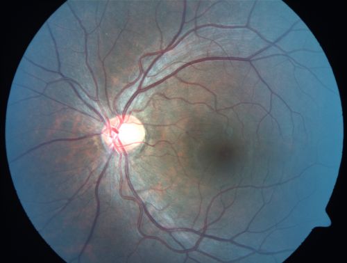 Congenital Toxoplasmosis with non-macular Scars Both Eyes - Recent Reactivation (recurrence) Right Eye
34-year-old man has congenital toxoplasmosis with four week history of foggy vision and new floaters in the right eye. OD is 20/40, OS 20/30

