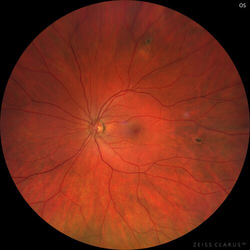 Recurrent toxoplasmosis with elevated IOP
48 year old man with 4 episodes over 40 years of vision loss from toxoplasmosis.  His IOP was 44 on presentation.
