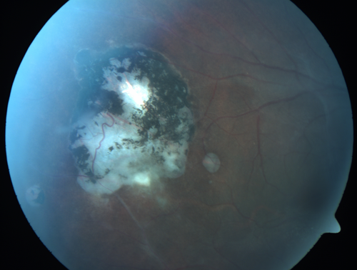 Recurrent Toxoplasmosis Right eye then Left eye 8 years later
33 year old brazilian man.  Initially presented with uveitis in the right eye in 2011.  Then in the left eye in 2019.  Since has had two more episodes.
