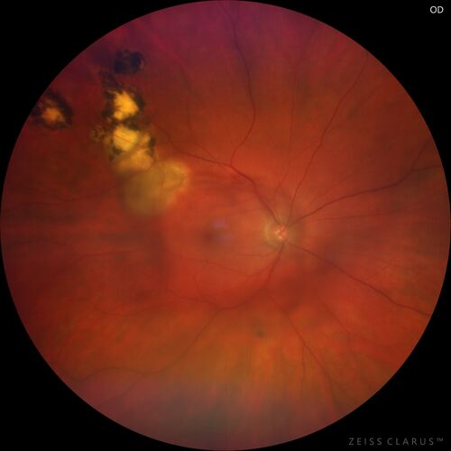 Recurrent toxoplasmosis with elevated IOP
48 year old man with 4 episodes over 40 years of vision loss from toxoplasmosis.  His IOP was 44 on presentation.
