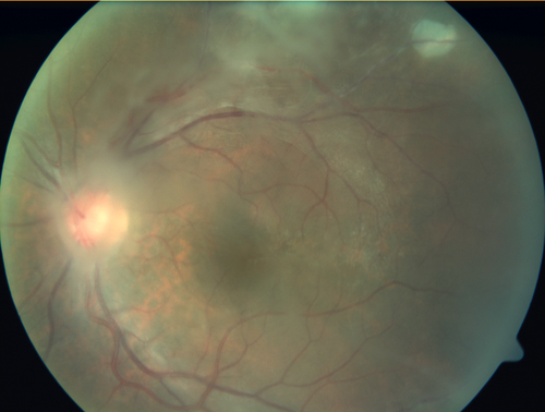 Recurrent Toxoplasmosis Right eye then Left eye 8 years later
33 year old brazilian man.  Initially presented with uveitis in the right eye in 2011.  Then in the left eye in 2019.  Since has had two more episodes.
