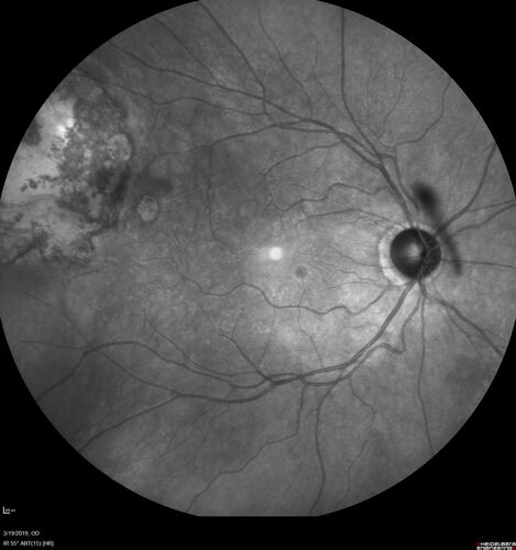 Recurrent Toxoplasmosis Right eye then Left eye 8 years later
33 year old brazilian man.  Initially presented with uveitis in the right eye in 2011.  Then in the left eye in 2019.  Since has had two more episodes.
