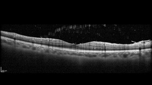 Recurrent Toxoplasmosis Right eye then Left eye 8 years later
33 year old brazilian man.  Initially presented with uveitis in the right eye in 2011.  Then in the left eye in 2019.  Since has had two more episodes.
