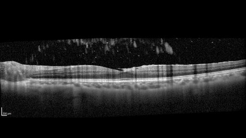 Recurrent Toxoplasmosis Right eye then Left eye 8 years later
33 year old brazilian man.  Initially presented with uveitis in the right eye in 2011.  Then in the left eye in 2019.  Since has had two more episodes.
