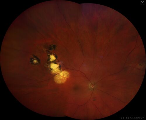 Recurrent toxoplasmosis with elevated IOP
48 year old man with 4 episodes over 40 years of vision loss from toxoplasmosis.  His IOP was 44 on presentation.
