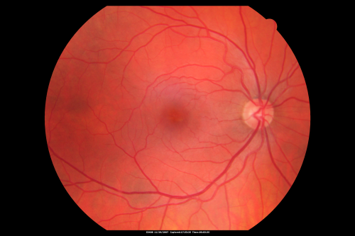 Toxoplasmosis - Inner Retinal - Recurrent - Treated with Bactrim DS 
43-year-old man has macular toxoplasmosis.   He has responded nicely to Bactrim OS:  20/60
Keywords: toxoplasmosis;retinitis;inner retina;recurrent