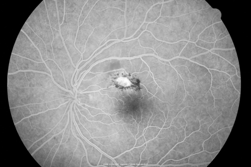 Toxoplasmosis - Inner Retinal - Recurrent - Treated with Bactrim DS 
43-year-old man has macular toxoplasmosis.   He has responded nicely to Bactrim OS:  20/60
Keywords: toxoplasmosis;retinitis;inner retina;recurrent