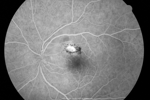 Toxoplasmosis - Inner Retinal - Recurrent - Treated with Bactrim DS 
43-year-old man has macular toxoplasmosis.   He has responded nicely to Bactrim OS:  20/60
Keywords: toxoplasmosis;retinitis;inner retina;recurrent