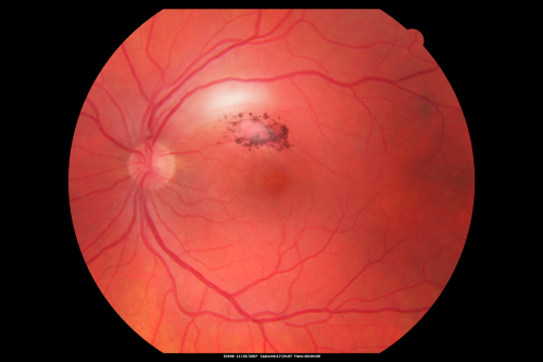 Toxoplasmosis - Inner Retinal - Recurrent - Treated with Bactrim DS 
43-year-old man has macular toxoplasmosis.   He has responded nicely to Bactrim OS:  20/60
Keywords: toxoplasmosis;retinitis;inner retina;recurrent