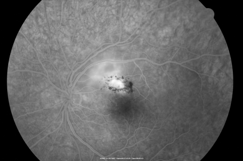Toxoplasmosis - Inner Retinal - Recurrent - Treated with Bactrim DS 
43-year-old man has macular toxoplasmosis.   He has responded nicely to Bactrim OS:  20/60
Keywords: toxoplasmosis;retinitis;inner retina;recurrent