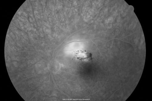Toxoplasmosis - Inner Retinal - Recurrent - Treated with Bactrim DS 
43-year-old man has macular toxoplasmosis.   He has responded nicely to Bactrim OS:  20/60
Keywords: toxoplasmosis;retinitis;inner retina;recurrent