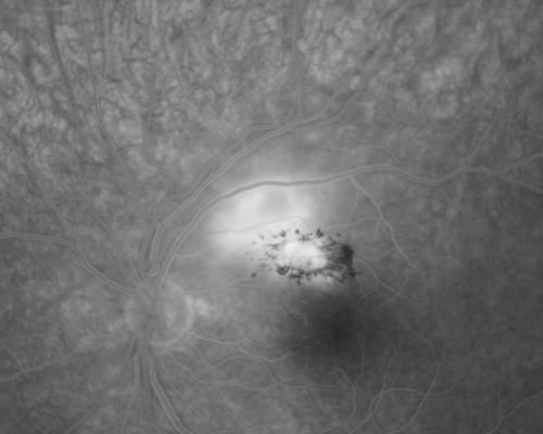 Toxoplasmosis - Inner Retinal - Recurrent - Treated with Bactrim DS 
43-year-old man has macular toxoplasmosis.   He has responded nicely to Bactrim OS:  20/60
Keywords: toxoplasmosis;retinitis;inner retina;recurrent