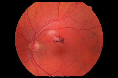 Toxoplasmosis - Inner Retinal - Recurrent - Treated with Bactrim DS 
43-year-old man has macular toxoplasmosis.   He has responded nicely to Bactrim OS:  20/60
Keywords: toxoplasmosis;retinitis;inner retina;recurrent