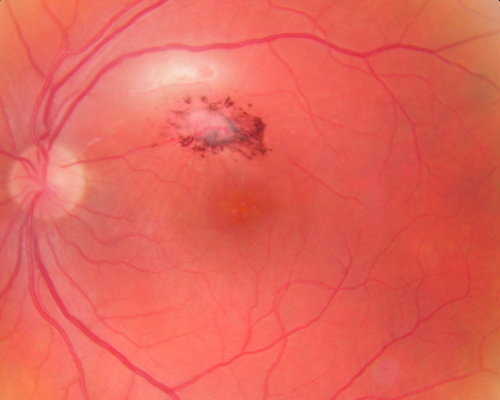 Toxoplasmosis - Inner Retinal - Recurrent - Treated with Bactrim DS 
43-year-old man has macular toxoplasmosis.   He has responded nicely to Bactrim OS:  20/60
Keywords: toxoplasmosis;retinitis;inner retina;recurrent